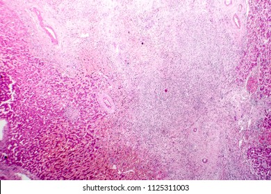 34 Micro Abscess Images, Stock Photos & Vectors | Shutterstock