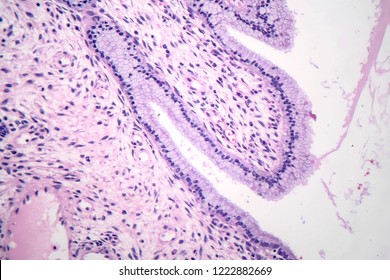 Histopathology Nasal Polyps Light Micrograph Photo Stock Photo ...