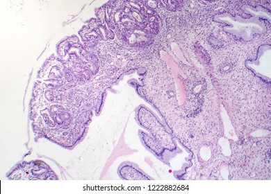 Histopathology Of Nasal Polyps, Light Micrograph, Photo Under Microscope