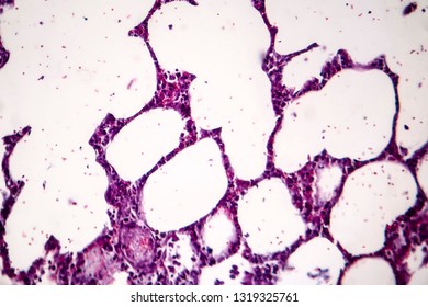 Histopathology Of Pneumonia, Light Micrograph, Photo Under Microscope. Cellulose Aspiration Pneumonia