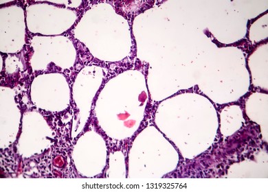 Histopathology Of Pneumonia, Light Micrograph, Photo Under Microscope. Cellulose Aspiration Pneumonia