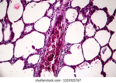 Histopathology Of Pneumonia, Light Micrograph, Photo Under Microscope. Cellulose Aspiration Pneumonia