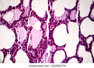 Histopathology Of Pneumonia, Light Micrograph, Photo Under Microscope. Cellulose Aspiration Pneumonia