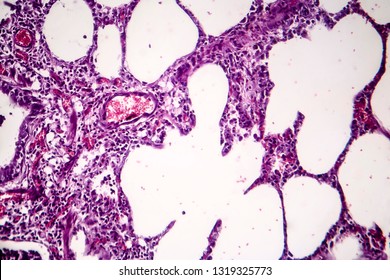 Histopathology Of Pneumonia, Light Micrograph, Photo Under Microscope. Cellulose Aspiration Pneumonia