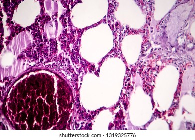 Histopathology Of Pneumonia, Light Micrograph, Photo Under Microscope. Cellulose Aspiration Pneumonia