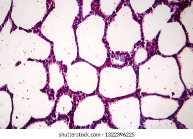 Histopathology Of Pneumonia, Light Micrograph, Photo Under Microscope. Cellulose Aspiration Pneumonia