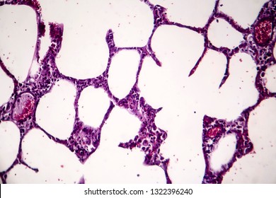 Histopathology Of Pneumonia, Light Micrograph, Photo Under Microscope. Cellulose Aspiration Pneumonia