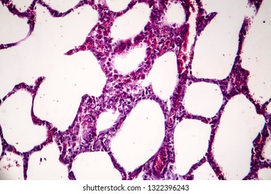 Histopathology Of Pneumonia, Light Micrograph, Photo Under Microscope. Cellulose Aspiration Pneumonia