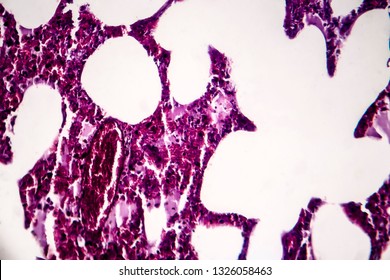 Histopathology Of Pneumonia, Light Micrograph, Photo Under Microscope. Cellulose Aspiration Pneumonia