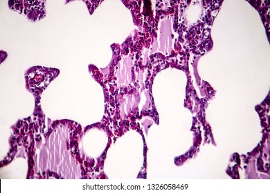 Histopathology Of Pneumonia, Light Micrograph, Photo Under Microscope. Cellulose Aspiration Pneumonia