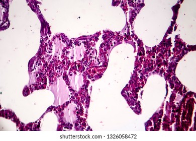 Histopathology Of Pneumonia, Light Micrograph, Photo Under Microscope. Cellulose Aspiration Pneumonia