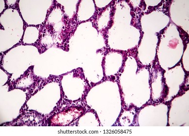 Histopathology Of Pneumonia, Light Micrograph, Photo Under Microscope. Cellulose Aspiration Pneumonia