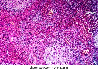 Histopathology Of Portal Liver Cirrhosis, Light Micrograph, Photo Under Microscope