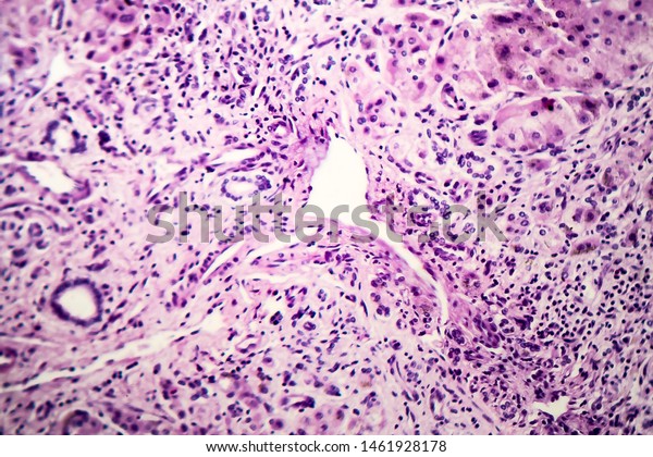 Histopathology Postnecrotic Liver Cirrhosis Light Micrograph Stock 