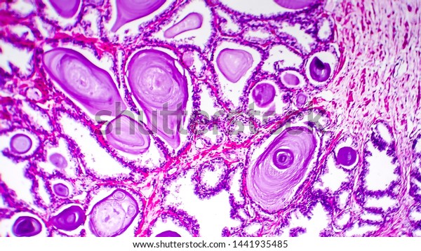 Histopathology Prostate Gland Hyperplasia Light Micrograph Stock Photo Edit Now
