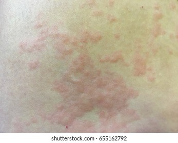 Hives Also Known As Urticaria, Is A Kind Of Skin Rash With Red, Raised, Itchy Bumps.