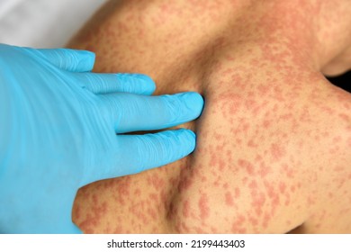 Hives Sprinkled All Over The Child's Back In Large Red Spots. Sick Child On Examination By A Doctor In A Children's Infectious Diseases Hospital