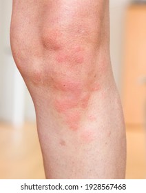 Hives (urticaria), A Skin Condition. Red Skin Rash On A Woman's Body, Skin Allergy, UK