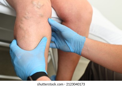 hlebologist examines a patient with varicose veins on his leg.