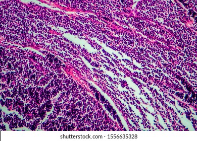 Hodgkin's Lymphoma, Light Micrograph, Photo Under Microscope