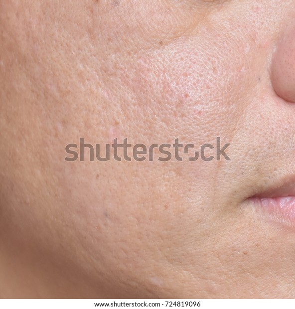 Holes On Rough Face Skin Happened Stock Photo (Edit Now) 724819096