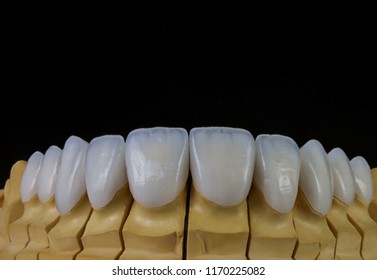 Hollywood Smile Veneers