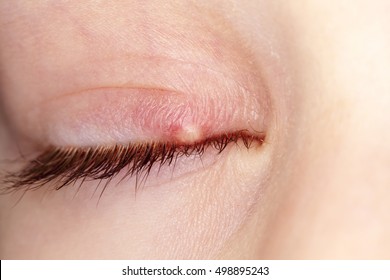 Hordeolum On The Child's Eye