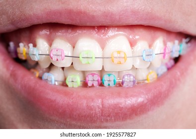 Horizontal Closeup Snapshot Of Beautiful Woman's Smile, Demonstrating White Healthy Teeth With Ceramic Brackets, United With Wire And Colorful Rubber Bands. Front View. Orthodontic Accessories Concept