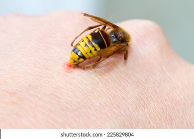 Hornet Sting On Hand