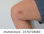 A Horsefly bite on a Ladies leg. 