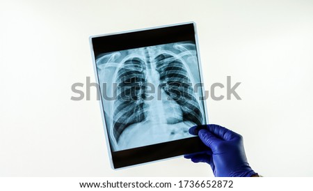 Hospital worker, doctor looks at x-ray, lungs,pneumonia,lung disease,close-up.Hands in medical gloves.Medical radiography of thorax.Light background.