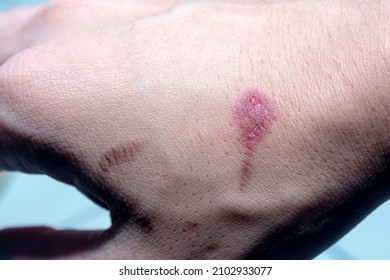 Hot Oil Burns On The Skin, Causing The Skin To Turn Red And Die. Wounds Caused By Scalding Hot Water. Wound Inflammation. Burns That Begin To Heal And Dry On The Skin