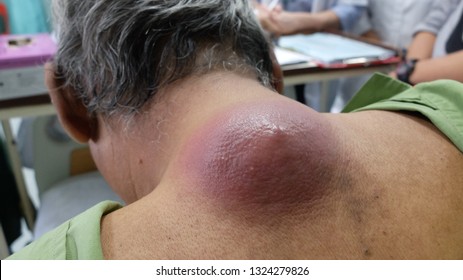 Huge abscess at the upper back due to Infected Sebaceous Cyst