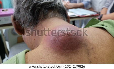 Huge abscess at the upper back due to Infected Sebaceous Cyst