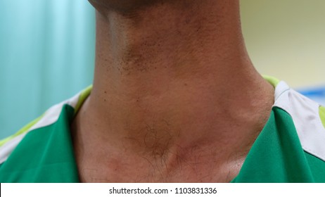Huge Anterior neck swelling, Left Thyroid swelling with Multinodular feature. Patient require Thyroidectomy operation.
