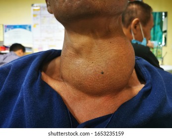 Huge Anterior Neck swelling represents Diffuse Benign  Thyroid Enlargement 