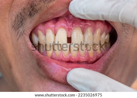 Huge gap between the front teeth or incisors of Asian Chinese man. Diastema.