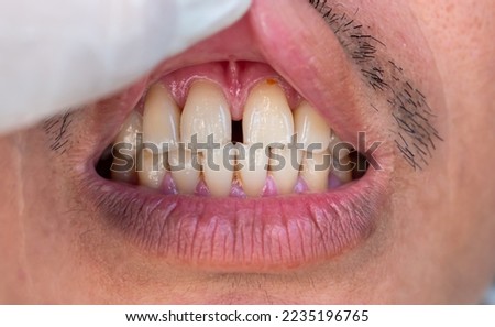 Huge gap between the front teeth or incisors of Asian Chinese man. Diastema.