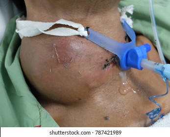 Huge Goitre due to Anaplastic Thyroid Carcinoma with tracheostomy tube due to airway obstruction.