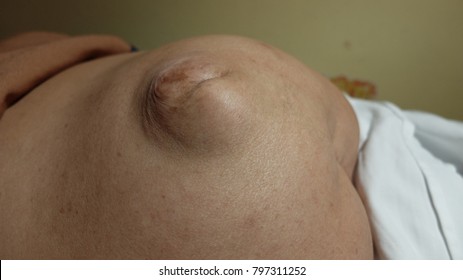 Huge Incisional Hernia Secondary To Previous Caesarian Section .