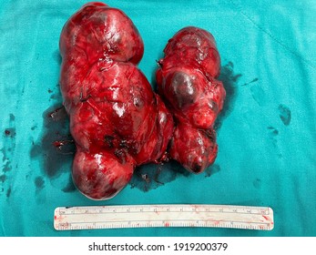 Huge Multinodular Goiter Post Surgery