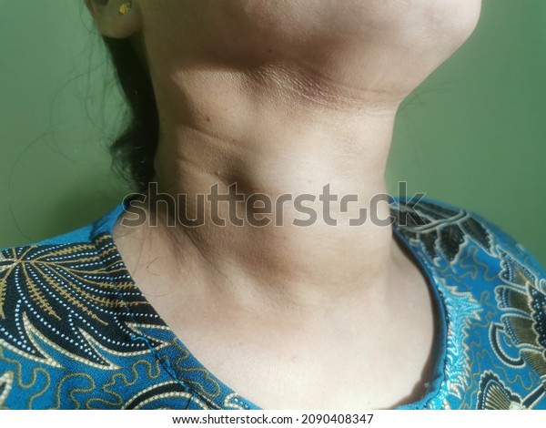 Huge Multinodular Goitre Asian Lady Stock Photo 2090408347 Shutterstock