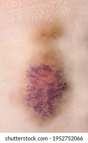 Huge Purple Bruise With Bleeding On Human Skin