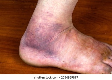 A Huge Purple Bruise On The Man's Foot. Sprain