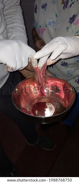 Huge tumor in fallopian tube successfully\
removed. Causing abdominal pain even infertility in women. The\
actual size of the tumor is little bigger than a cricket ball\
filled with water. In the\
picture