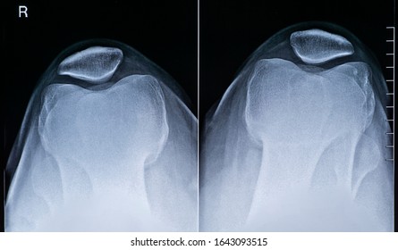 Human Adult Male Right Knee Anatomy Top View X-ray Image. Radiography And Medical Imagery.