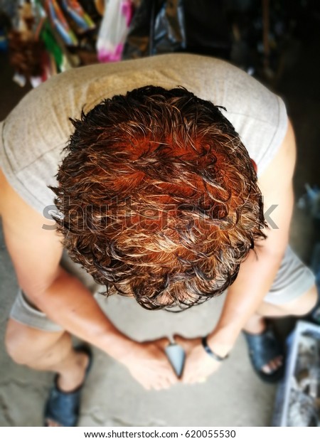 Human Alopecia Hair Loss Adult Man Royalty Free Stock Image