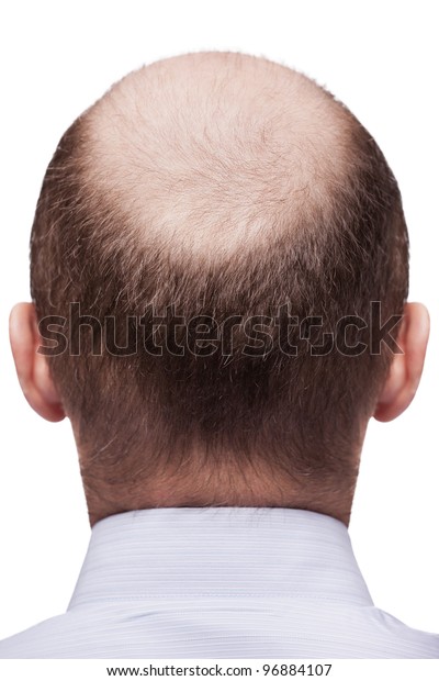 Human Alopecia Hair Loss Adult Man Stock Photo Edit Now 96884107