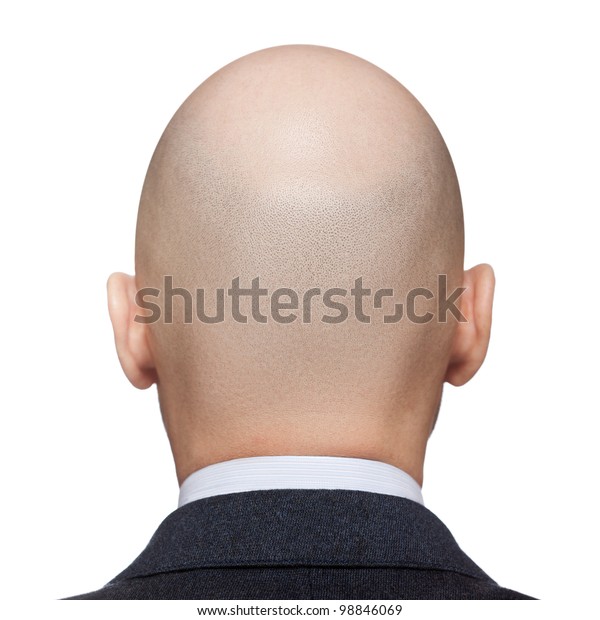 ヒト脱毛症または脱毛症 成人男性の禿頭の後部または背面 の写真素材 今すぐ編集