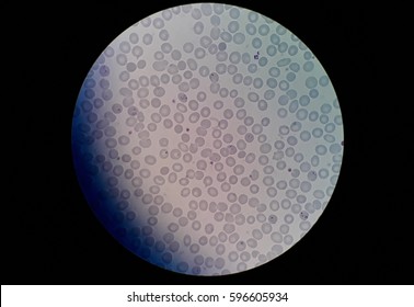 Human Blood Smear With Malaria Infected Red Blood Cells, Under 100X Light Microscope Which Bad Objective Lens Focused.